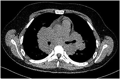 Hypercalcemia, an Important Puzzle Piece in Uncommon Onset Pediatric Sarcoidosis—A Case Report and a Review of the Literature